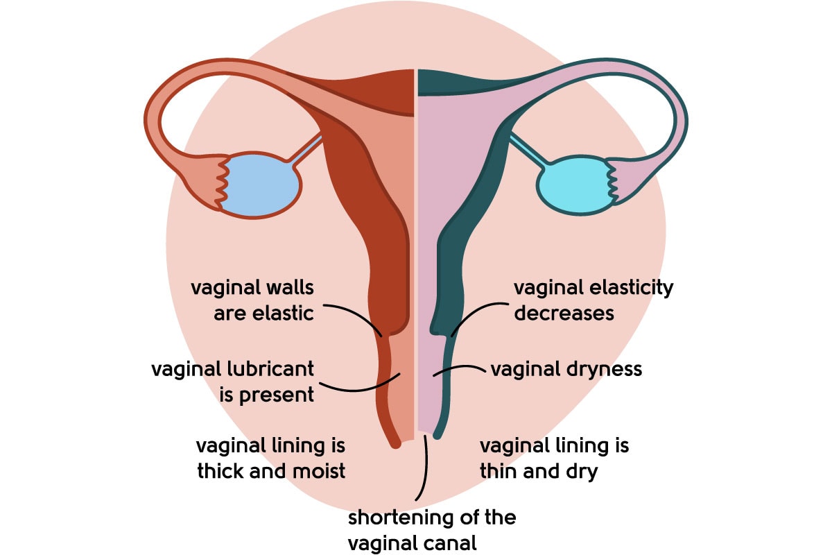 Menopause Symptoms, Bladder infections