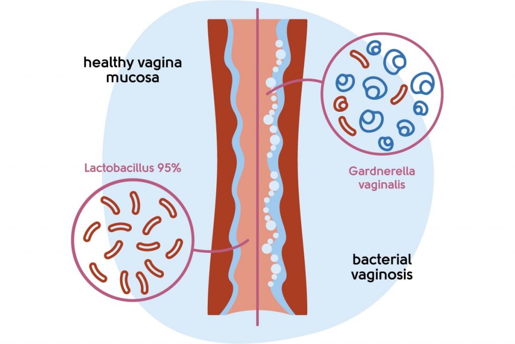 Menopause Symptoms, Vaginal Dryness