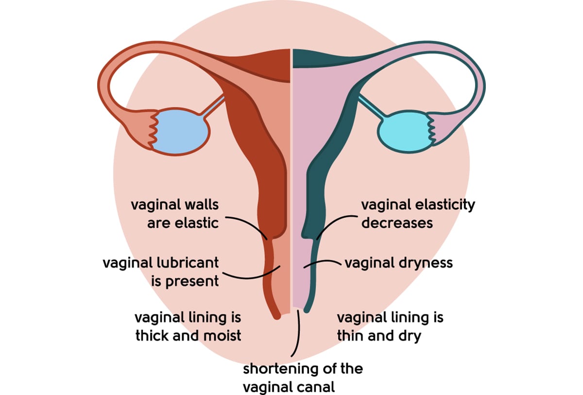 Healthy vagina vs urogenital atrophy