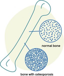 Osteoporosis diagram